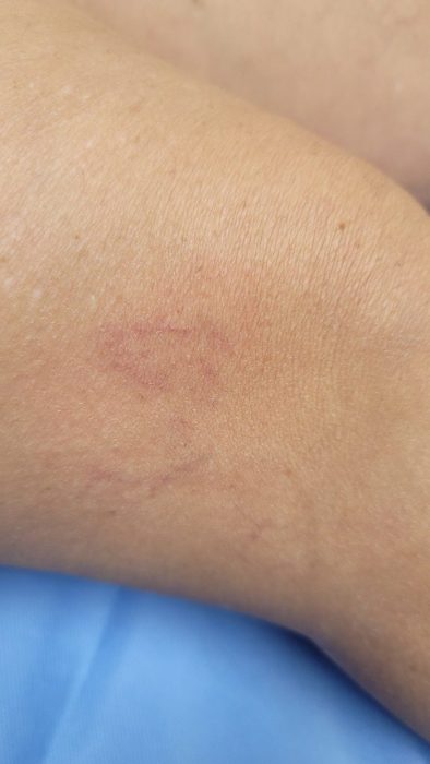 newveins